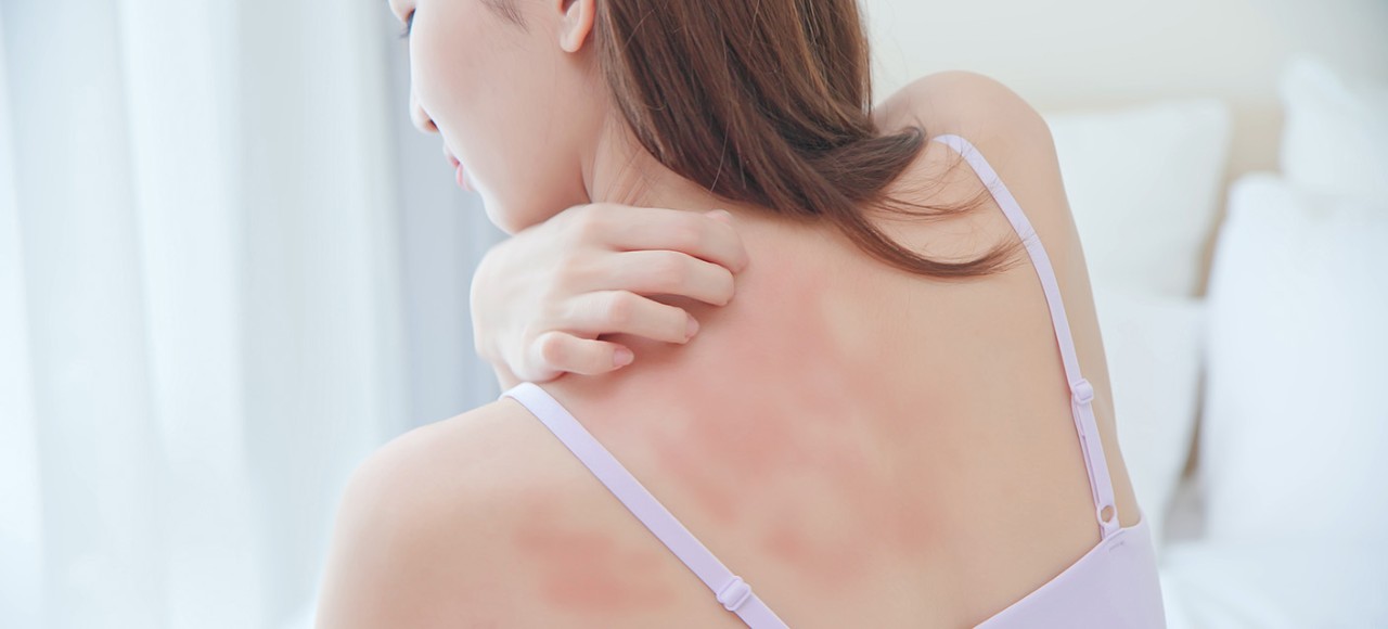 【濕疹自救】3大誘發濕疹原因 改善濕疹症狀、止癢方法、食療全攻略